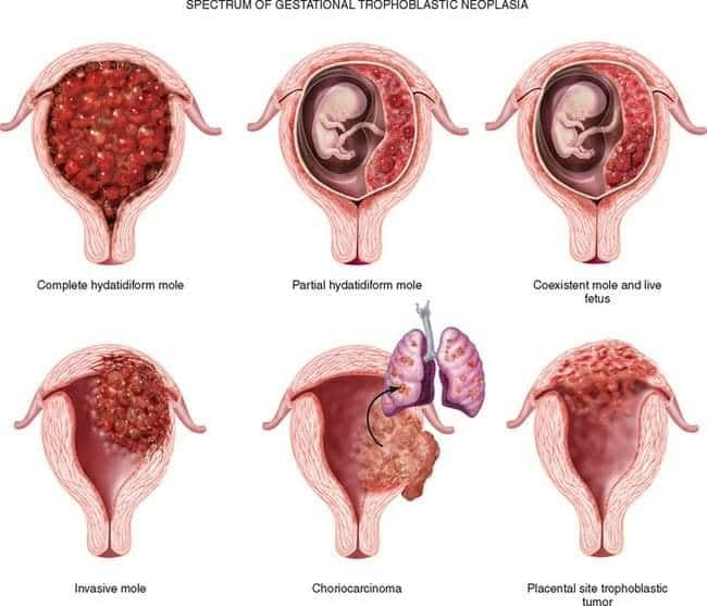 Gestational trophoblastic tumours