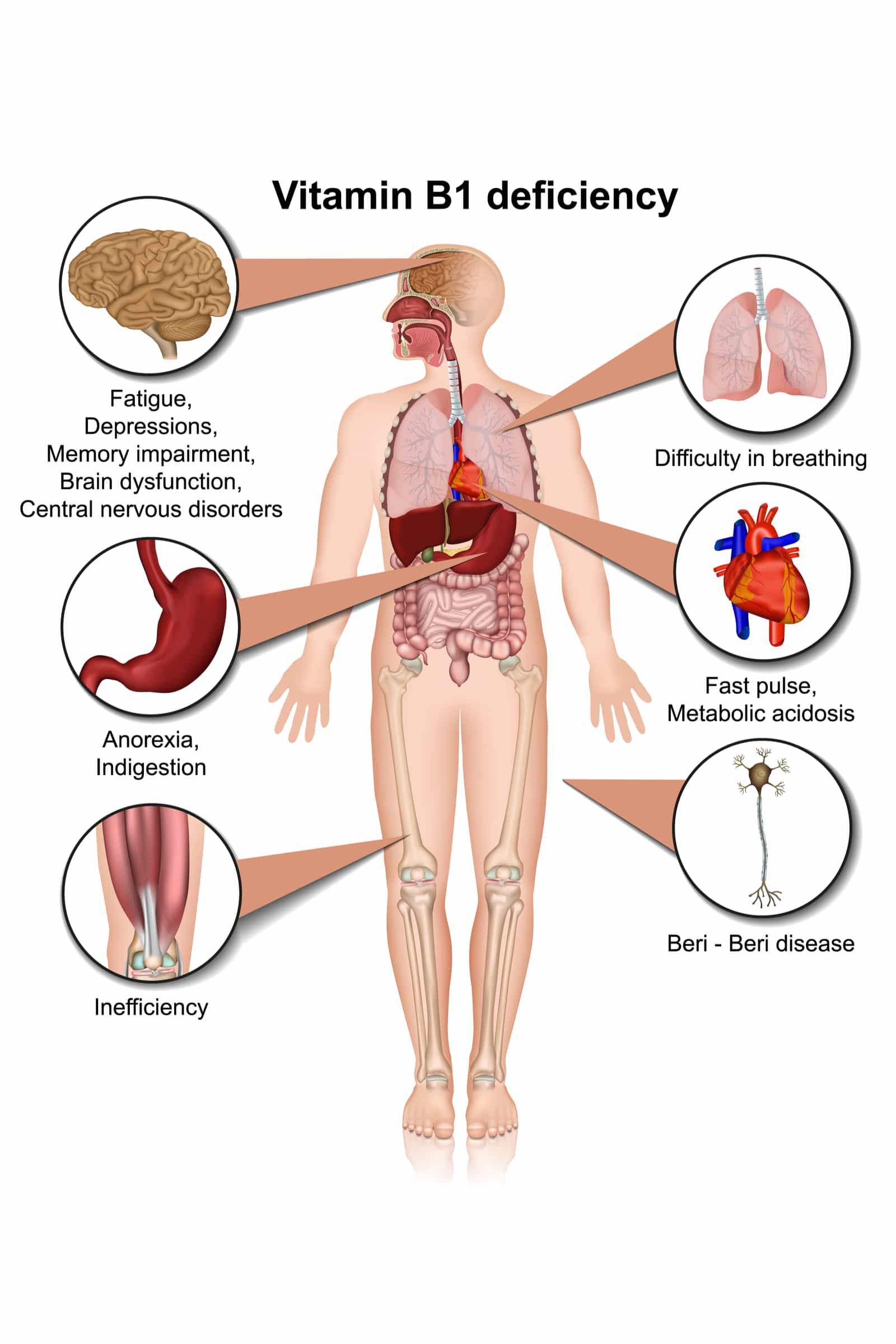 Understanding Thiamine Deficiency After Bariatric Surgery