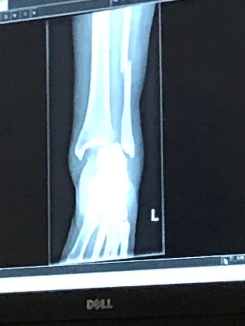 ankle fracture x ray rotated