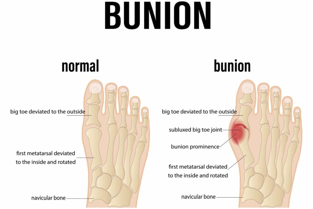bunions