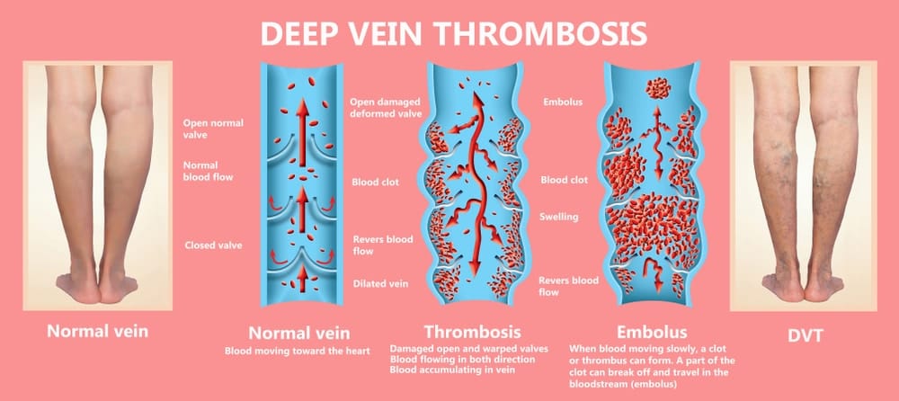 deep vein thrombosis