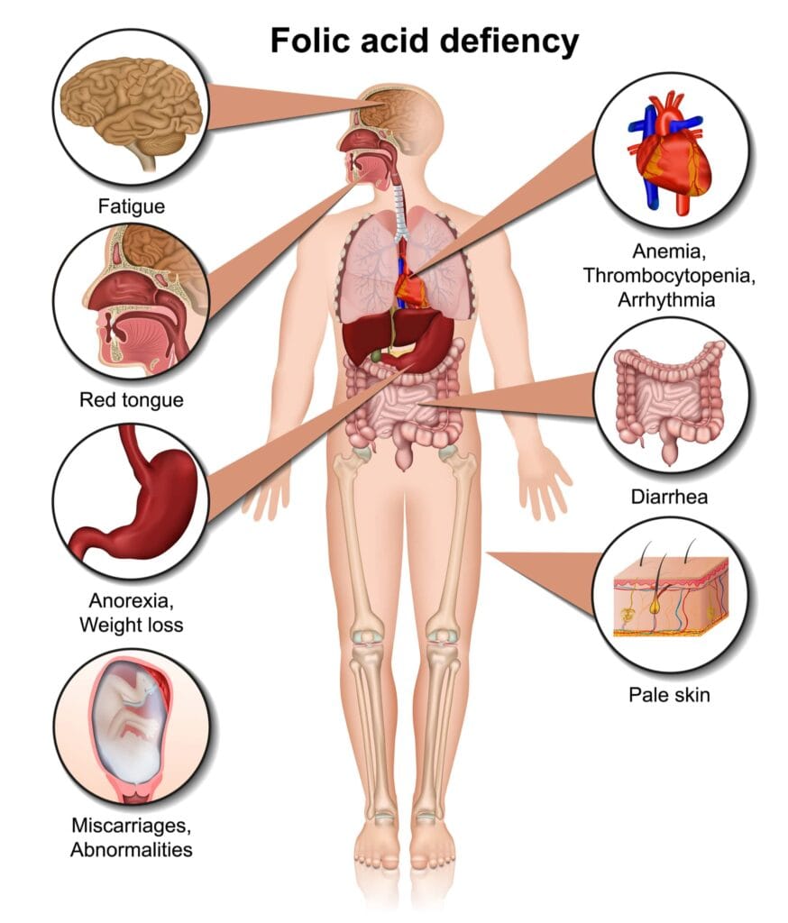 folic acid deficiency after bariatric surgery effects