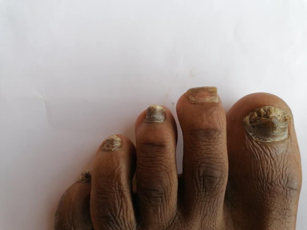 fungal nail infection