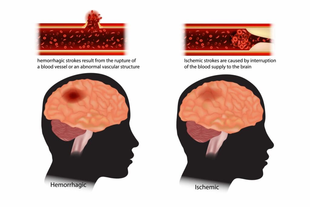 haemorrhagic vs Ischaemic stroke scaled