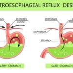 how to treat gerd after gastric sleeve