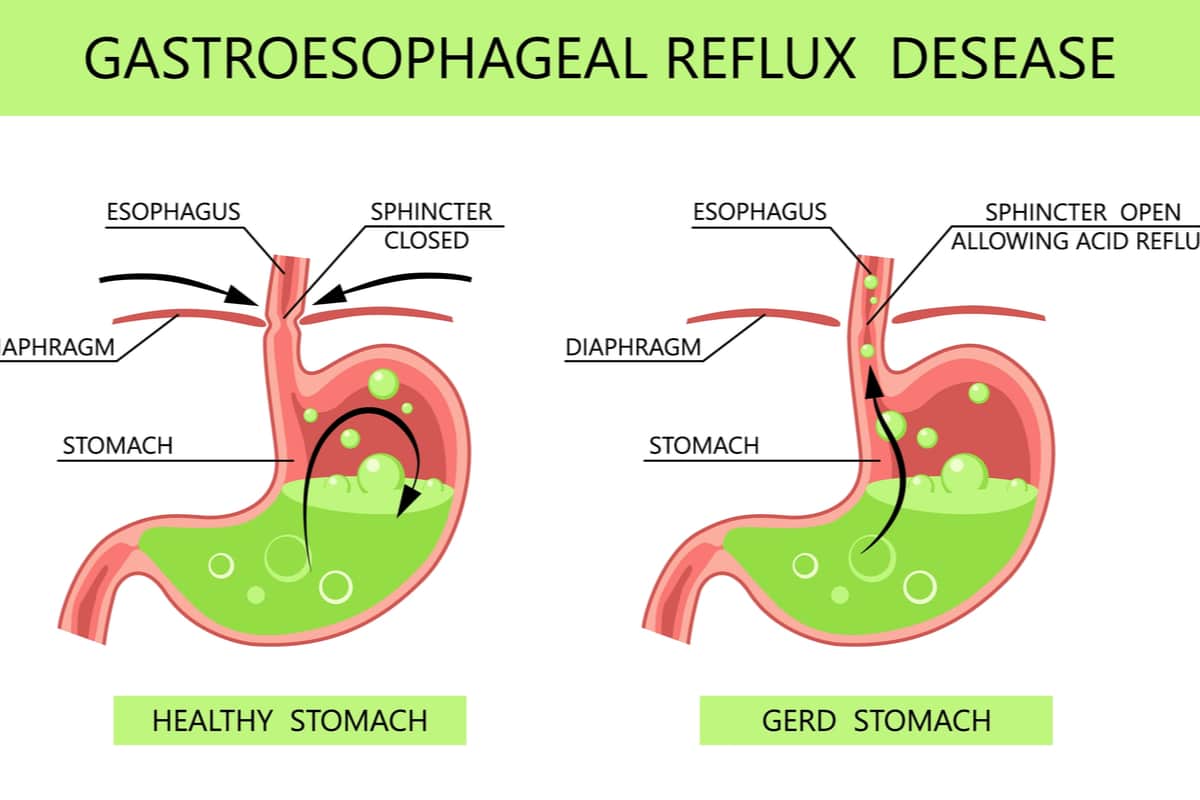 how to treat gerd after gastric sleeve