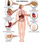 iron deficiency anaemia after bariatric surgery effect