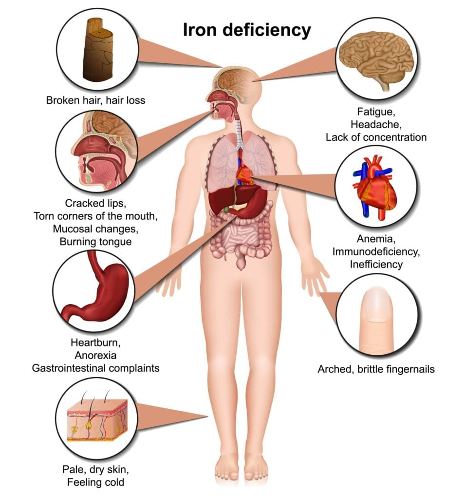 iron deficiency anaemia after bariatric surgery effect