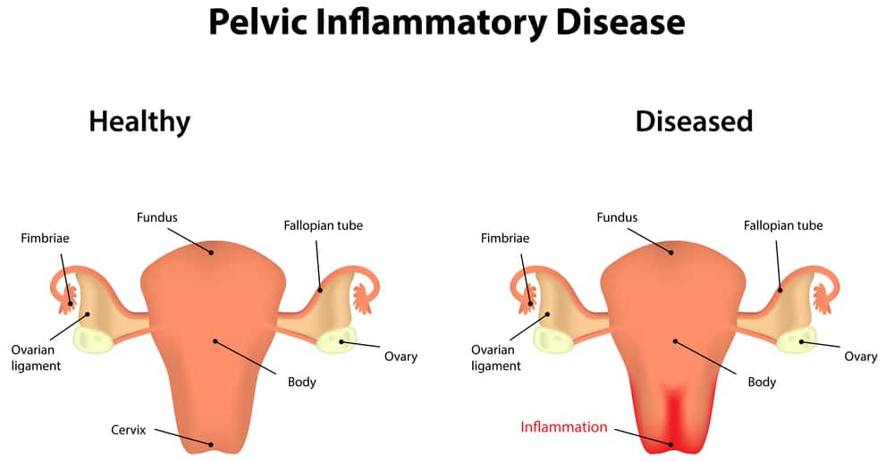 pelvic inflammatory disease