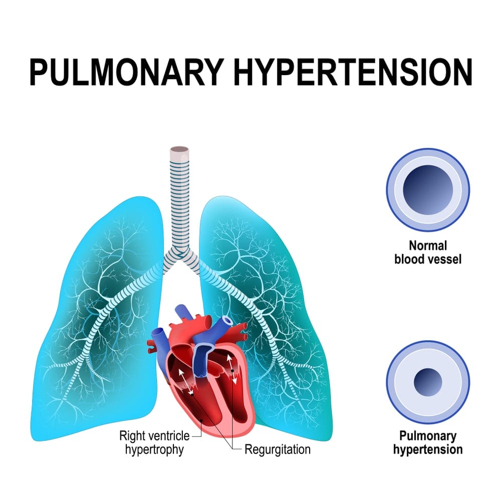 pulmonary hypertension