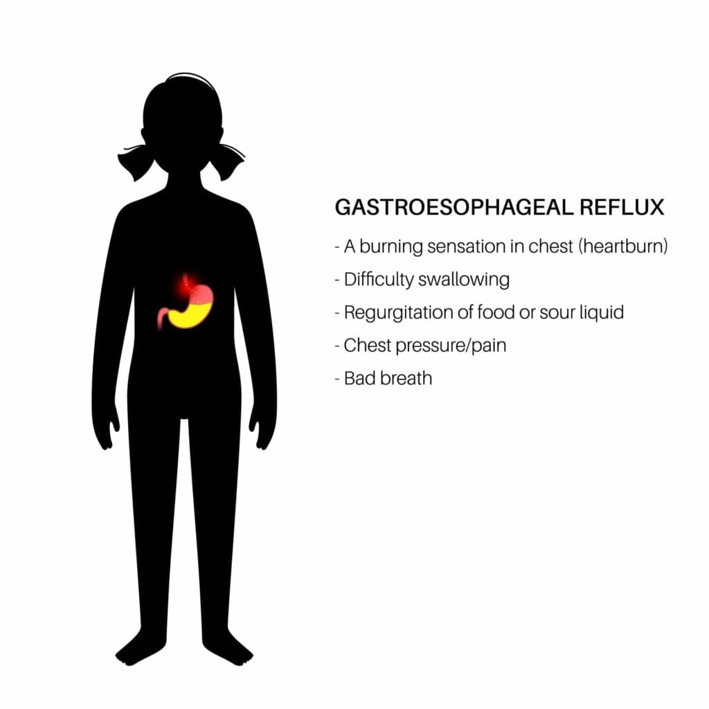 signs of acid reflux after gastric sleeve